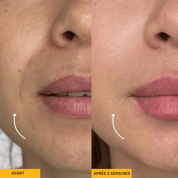 MIVO Brosse Lymphatique — Dégonfle, Sculpte Et Redéfinis En 3 Minutes - MyMiivo